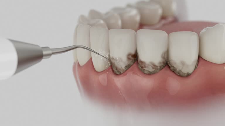 Trusted Wisdom Tooth Removal service in Pearl River, MS - Dentist Open Now